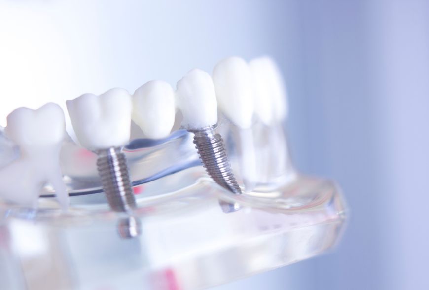 ventajas implantes subcrestales