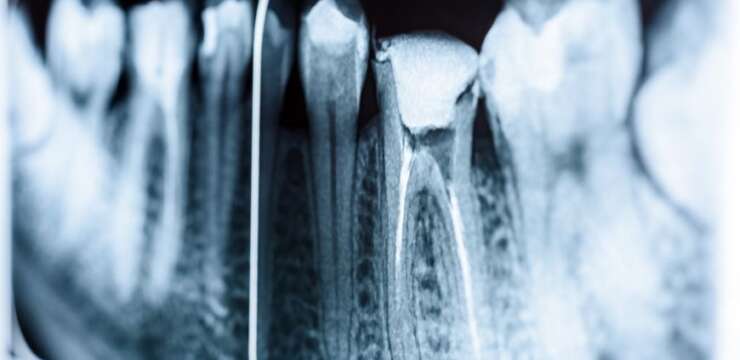endodoncia