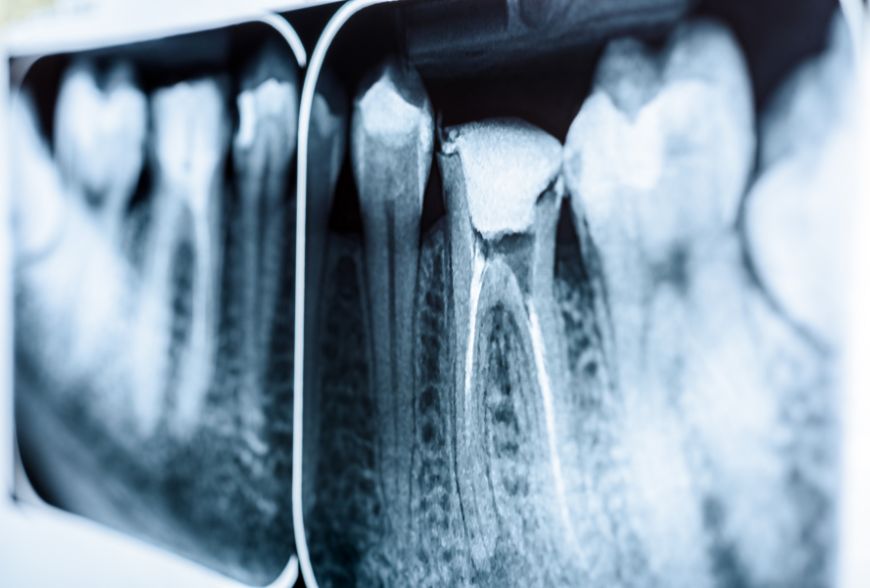 endodoncia